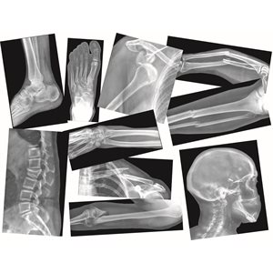 Broken Bones X-Rays ~PKG 15